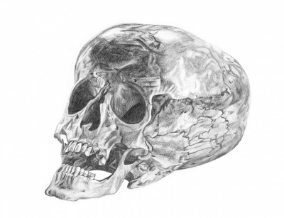 Hydrocephalus Skull